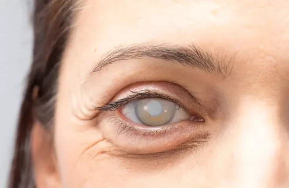 6 Cara Mencegah Mata Katarak Sedari Muda, Penyakit yang Mengintai Usia Tua
