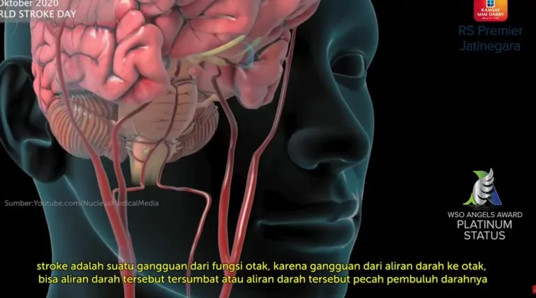 6 Gejala Umum Stroke yang Harus Diwaspadai, Salah Satunya pada Keseimbangan